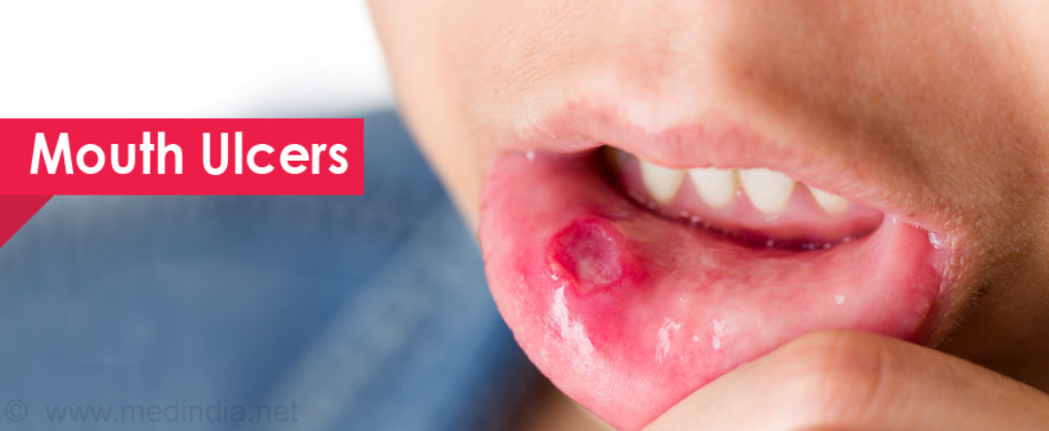 Mouth Ulcer Treatment