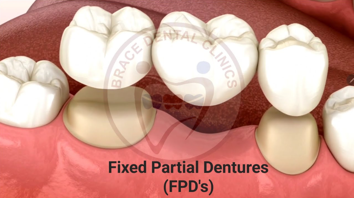 Fixed Partial Denture (FPD)