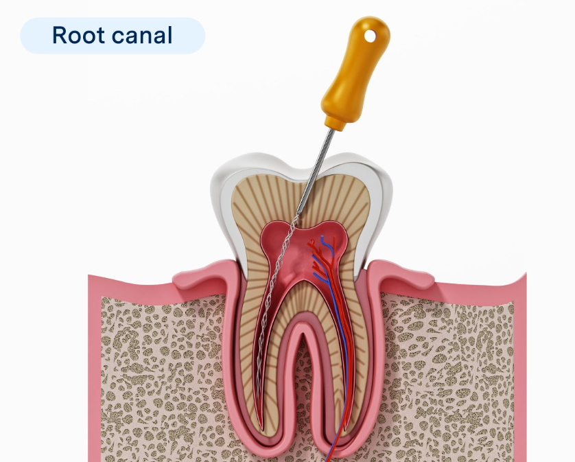 Root Canal Treatment
